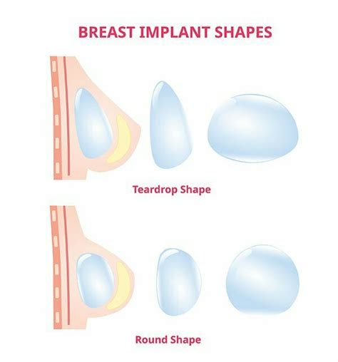 breast expansion meaning|Breast Augmentation